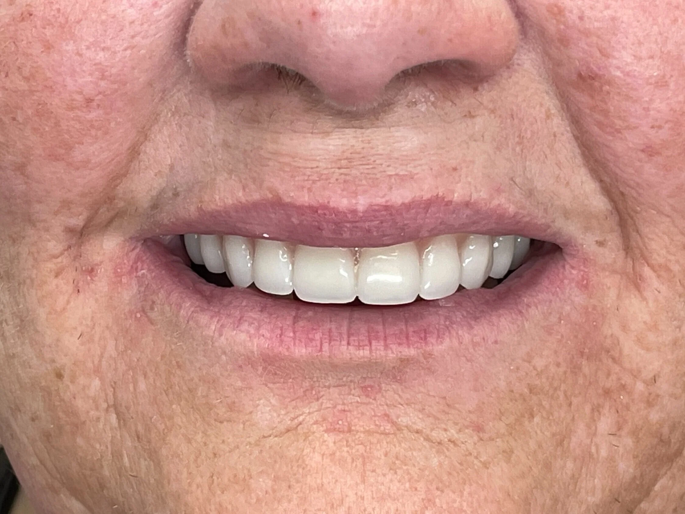 Smile Gallery Before and After Pics -Innovative Dentistry Biltmore